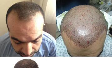 Top view - Before and after surgical hair replacement