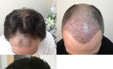 Top view - Before and after surgical hair replacement