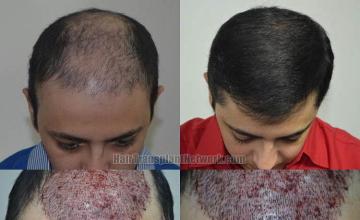 Hair transplantation surgery before and after photos