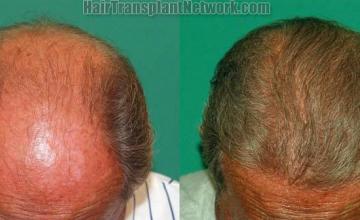 Hair restoration procedure before and after result photos