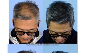 Hair transplantation surgery before and after photos