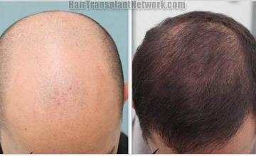 Hair restoration procedure before and after photo results