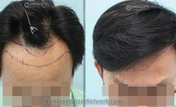 Hair transplantation surgery before and after images