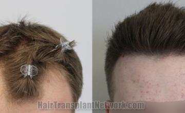 Top view - Before and after hair restoration results