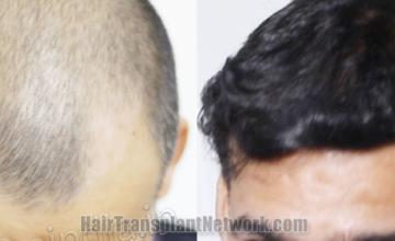 Top view - Before and after hair restoration results