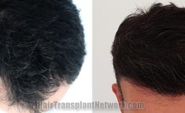 Top view - Before and after hair restoration results