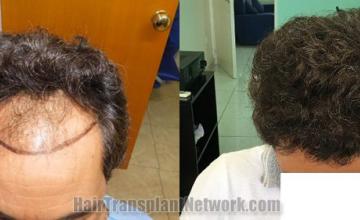 Top view - Before and after hair restoration results