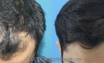 Top view - Before and after hair restoration results