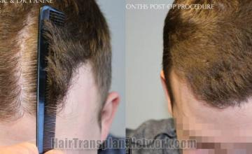 Top view - Before and after hair restoration results