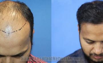 Top view - Before and after surgical hair replacement