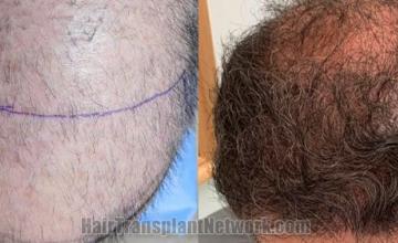 Top view - Before and after hair restoration results