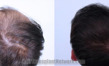 Top view - Before and after hair restoration results