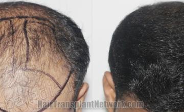 Top view - Before and after hair restoration results