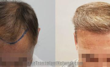 Top view - Before and after hair restoration results