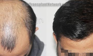 Top view - Before and after hair restoration results