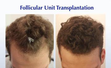 Hair transplantation surgery before and after images