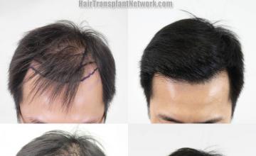 Before and after hair restoration procedure images