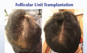 Before and after hair restoration procedure images