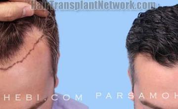 Hair transplantation surgery before and after images