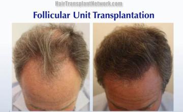 Hair transplantation surgery before and after images