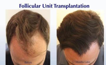 Before and after hair restoration procedure images