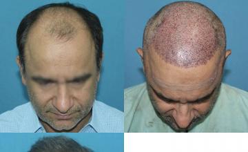 Hair transplantation surgery before and after images