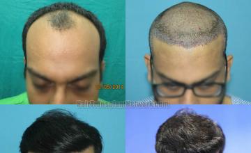 Hair transplantation surgery before and after images