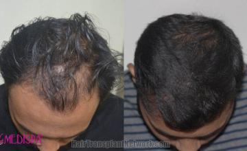 Hair transplantation surgery before and after images