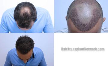 Hair transplantation surgery before and after images