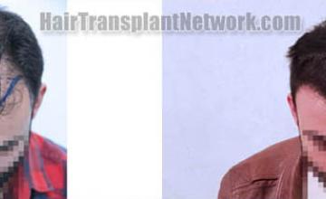 Hair transplantation surgery before and after images