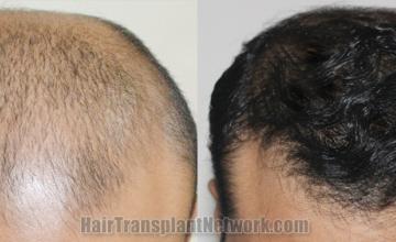 Top view - Before and after hair restoration results