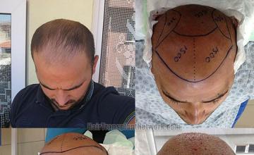 Hair transplant surgery before and after photos