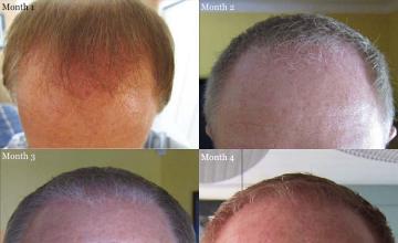 Hair restoration procedure before and after results