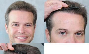 Hair restoration procedure before and after results