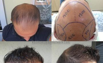 Hair transplant surgery before and after result photographs