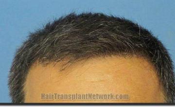 Hair restoration procedure results