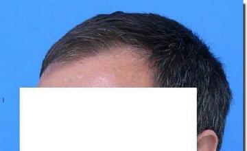 Hair restoration procedure results