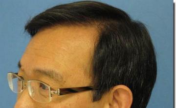 Hair restoration procedure results