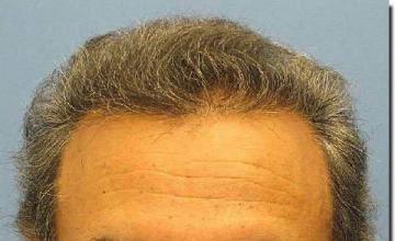 Hair restoration procedure results