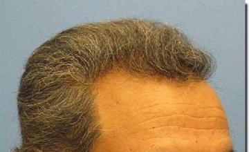 Hair restoration procedure results