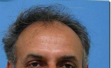 Hair restoration procedure results