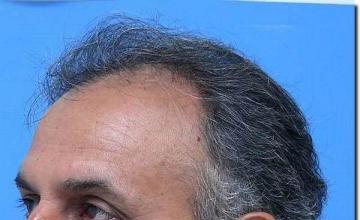 Hair restoration procedure results