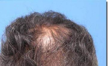 Hair restoration procedure results