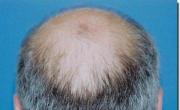 Hair restoration procedure results