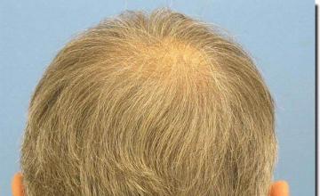 Hair restoration procedure results