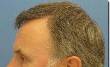 Hair restoration procedure results