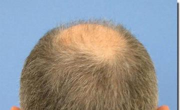 Hair restoration procedure results