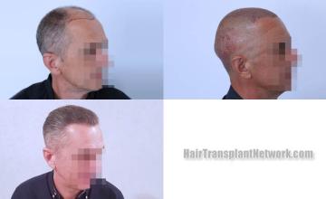 Hair transplantation procedure before and after results