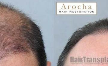 Hair restoration procedure before and after results