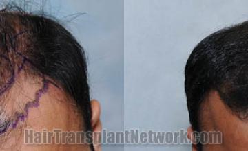 Top view - Before and after hair restoration procedure